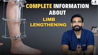 Complete Information About Limb Lengthening Surgery  Height increase Surgery  Height surgery [upl. by Neyut]