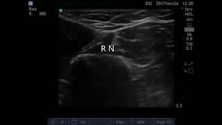 USG SCREENING OF ABOVE ELBOW NERVE BLOCKS [upl. by Lemuela]