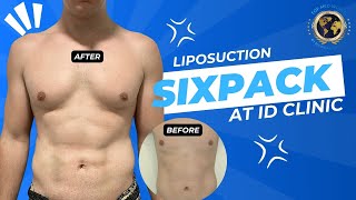 liposuction for SIXPACK at ID CLINIC BANGKOK THAILAND [upl. by Clippard]