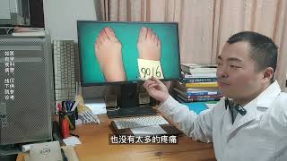 hallux valgus 双足不同程度拇外翻，是否都需要手术 [upl. by Bibby]