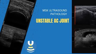 Unstable Acromioclavicular joint on ultrasound [upl. by Sandy]