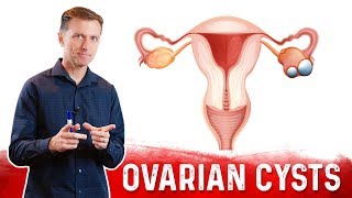 Ovarian Cysts Causes Symptoms amp Natural Treatment – DrBerg [upl. by Filipe]