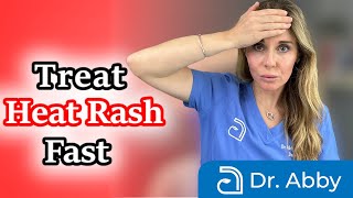 How to identify and treat heat rash fast [upl. by Lumbard]