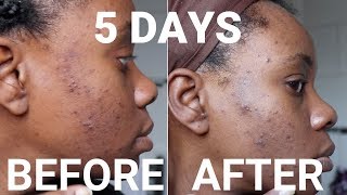 Turmeric face mask before and after 😮 [upl. by Inahpit]