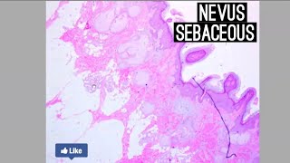 Nevus Sebaceous [upl. by Clementius]