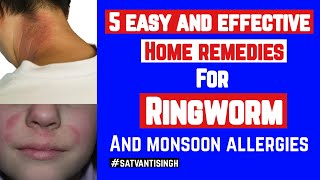 5 Easy amp Effective Home Remedies For Ringworm and monsoon allergies [upl. by Shela846]