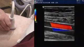 How To Lower Extremity Arterial Duplex Exam [upl. by Mickey927]