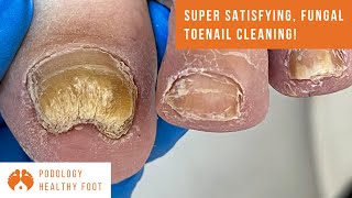 SUPER SATISFYING FUNGAL TOENAIL CLEANING ASMR  BRING THE PILLOWS [upl. by Ahsirt622]