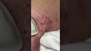 Big Cystic Acne Blackheads Extraction Blackheads amp Milia Whiteheads Removal Pimple Popping shorts [upl. by Early]