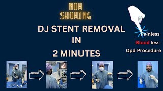 DJ STENT REMOVAL in 2 mins  LIVE Surgery Office  OPD Procedure [upl. by Llywellyn10]