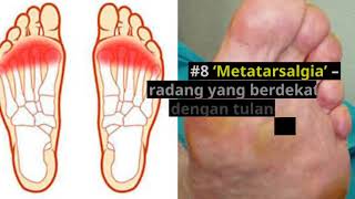 Apakah Penyebab Sakit Tapak Kaki Heel Pain [upl. by Convery]