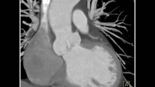 Cardiac Dilated aortic root and sinuses of Valsalva 7 of 10 [upl. by Siuraj]