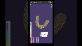 Exocad Veneer Design Tutorial  StepbyStep Digital Workflow for Perfect Smiles digitaldentistry [upl. by Cigam673]