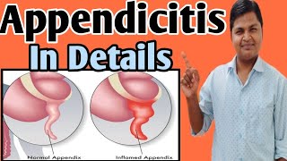 Appendicitis Anatomy  Cause Diagnosis Symptoms Treatment appendectomy [upl. by Anovad919]