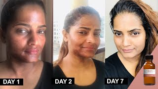 25 TCA Chemical Peel at home method and progress by Hina UrduHindi [upl. by Rebecca]