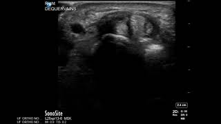 Wrist Ultrasound De Quervains Tenosynovitis Corticosteroid Injection [upl. by Inez250]