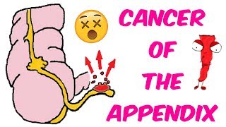 Cancer of the Appendix All the basics [upl. by Icat]