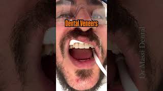 Dental Veneers [upl. by Yendirb124]