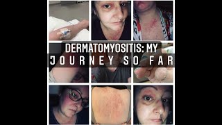 DERMATOMYOSITIS My Journey So Far [upl. by Aneeb]