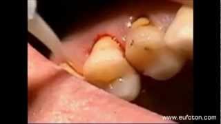 Dentistry  Laser Periodontal Pocket Decontamination  Decontaminazione Tasca Parodontale [upl. by Holcomb748]