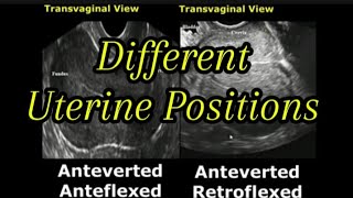 Uterine Positions In Ultrasound  AntevertedRetroverted  AnteflexedRetroflexed Uterus [upl. by Stoat5]