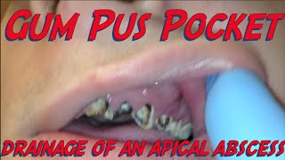 a pus pocket in the gum [upl. by Leunamnauj]