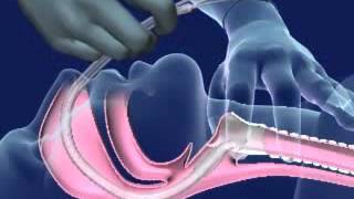 Nasal Intubation [upl. by Nitram]