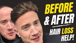 Before amp After  Hair System  Hair Loss To Full Hair In Minutes  Hair Replacement System Men UK [upl. by Benedetto]