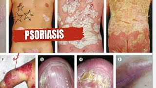 TOPICquot20 PSORIASIS amp ITS SYMPTOMS DIAGNOSIS AND TREATMENT [upl. by Zoe588]