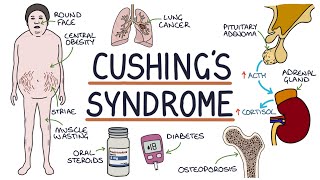 Understanding Cushings Syndrome [upl. by Placida994]