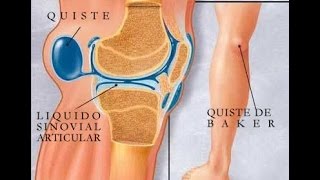 Quiste de Baker o popliteo Rodilla [upl. by Xaviera266]