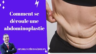 Comment se déroule une abdominoplastie [upl. by Ised]