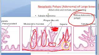 Pathology 521 g Neoplastic polyp tubular adenomatous villous papilloma tubulovillous papillary [upl. by Navis]