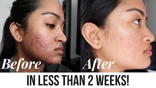 Acne Treatment Facial Peel  Before and After  SilasQiu [upl. by Artema]