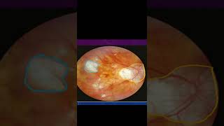 Fundus findings  pathological myopia [upl. by Hctud]