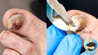 SUPER THICK TOENAIL TRIMMING AND FILING [upl. by Scheider]