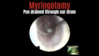 Endoscopic MyringotomyPus drained from middle ear by puncturing the eardrum [upl. by Nelo]