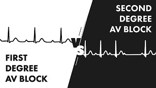 First vs Second Degree Heart Block  EKG Rhythm Interpretation [upl. by Poliard]