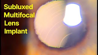 Subluxed synergy multifocal lens How we fix this [upl. by Howie]