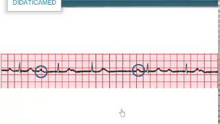 Bradicardia [upl. by Wystand482]