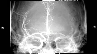 Balloonassisted coil embolization of small intracranial aneurysms [upl. by Einaled]