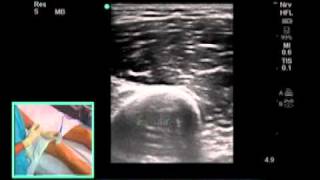 How to Ultrasound Guided Saphenous Nerve Block Scanning Technique [upl. by Mattias]