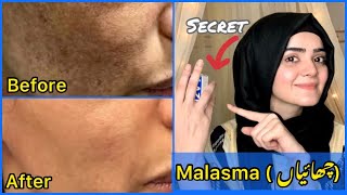 How To Get Rid Of Malasma  Best Medicated Cream 100 Effective  Self Experienced  Dietitian Aqsa [upl. by Giffard]