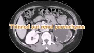 Left renal grade 4 hydronephrosis  CT [upl. by Gabriella660]