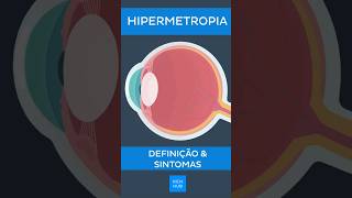 Hipermetropia Definição e sintomas  Kenhub hipermetropia [upl. by Rehpotisrhc]