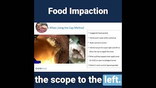 A Novel Technique for Esophageal Food Impaction [upl. by Jestude159]