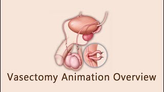 Vasectomy Animation Overview [upl. by Teloiv281]