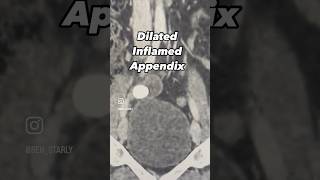 appendicitis computedtomography abdomen acute radiology [upl. by Togram]