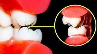 Comment Arrêter de Grincer Des Dents la Nuit [upl. by Madelina930]