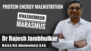 PROTEIN ENERGY MALNUTRITION PEM Kwashiorkor and Marasmus [upl. by Ripley]